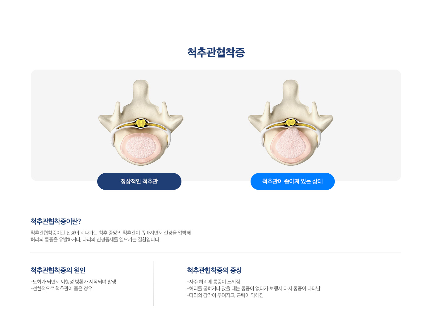 척추관협착증