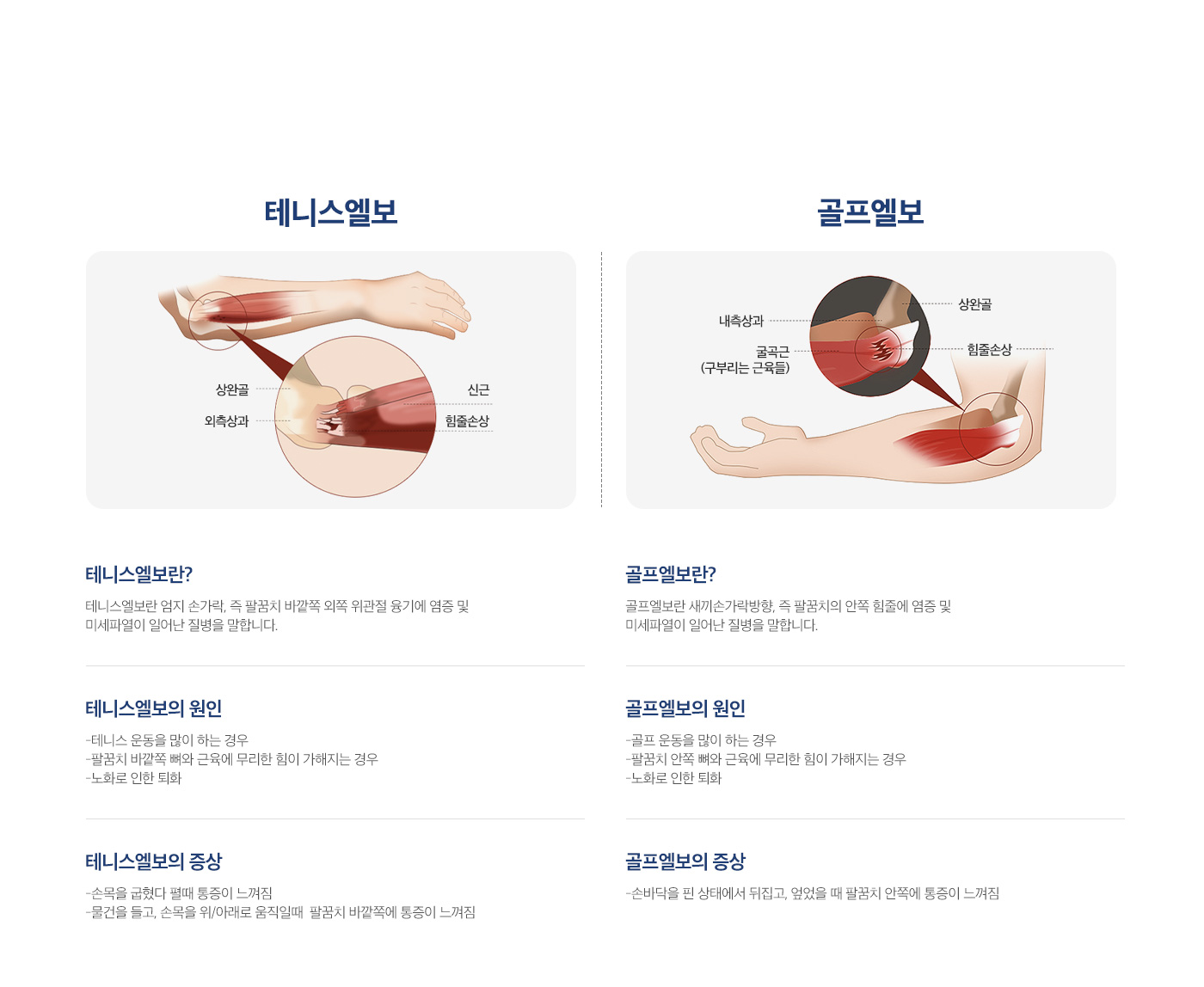 테니스/골프엘보
